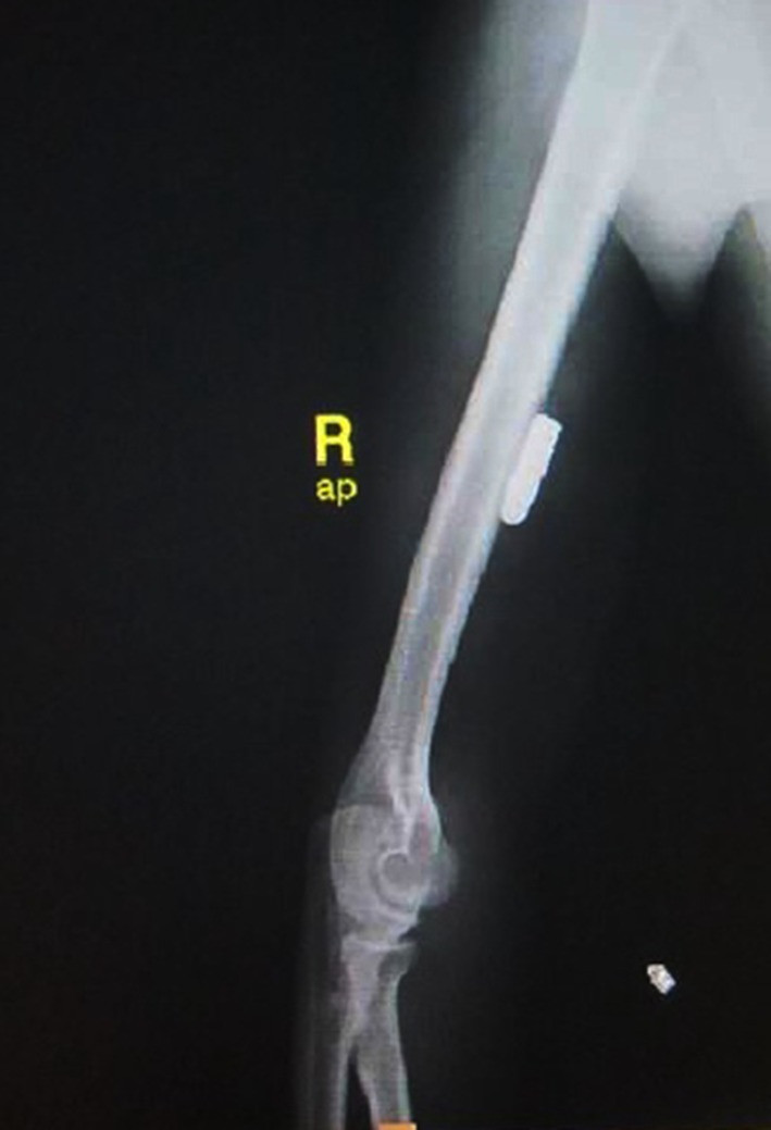 X-rays of the arm taken after the injury showing bullet inside the proximal arm