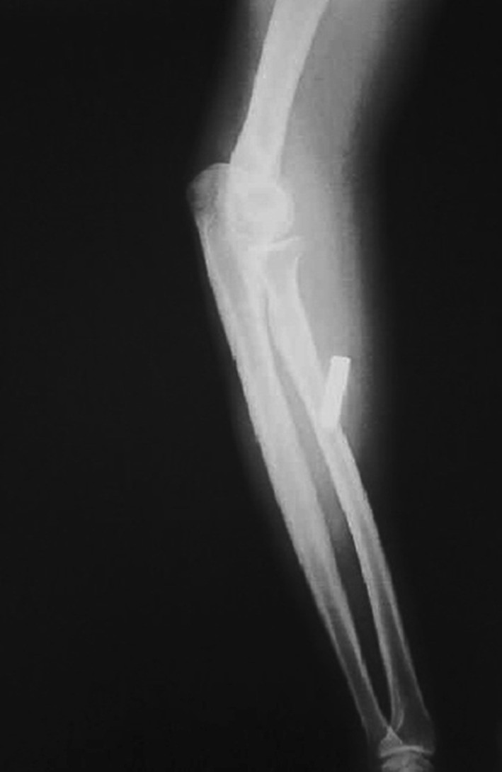 Radiographs taken after 3 months of the injury showing migration of bullet in the proximal forearm