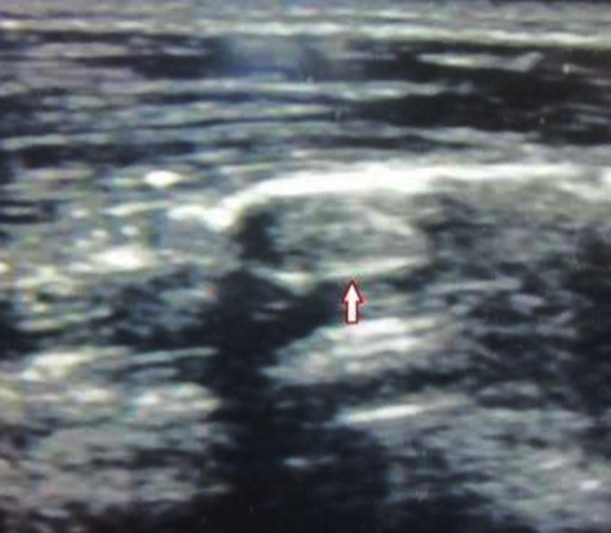 Ultrasonographic localization of the bullet (bullet marked with *arrow*)
