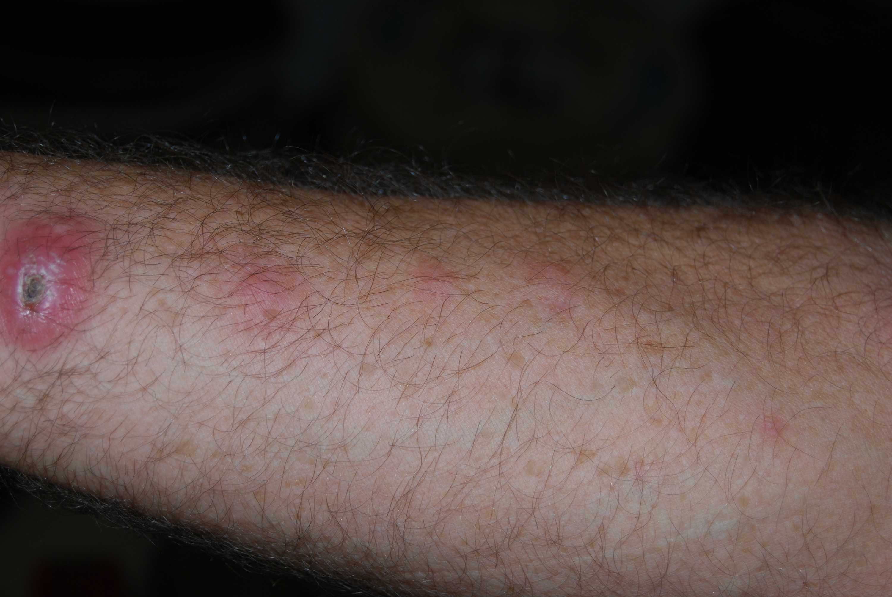 Splinter Removal