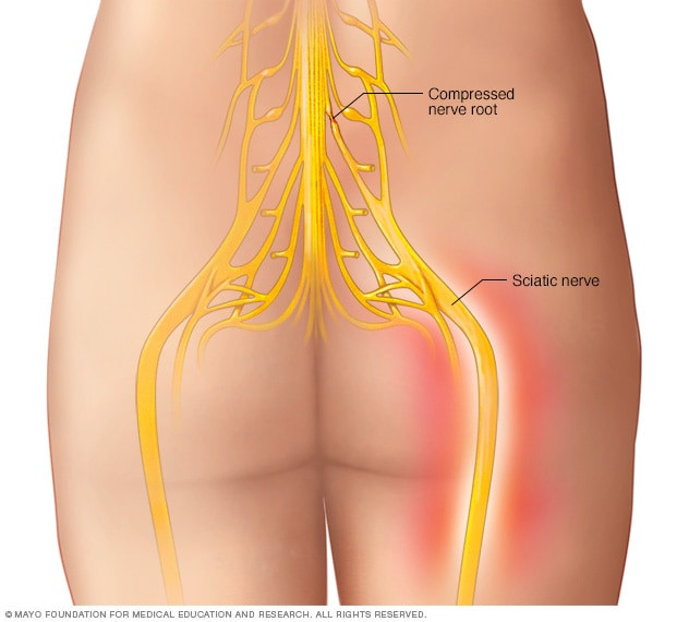 Sciatica Pain