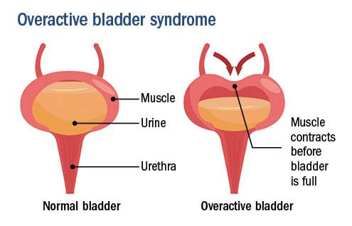 Illustration showing behavior of a normal bladder versus an overactive bladder