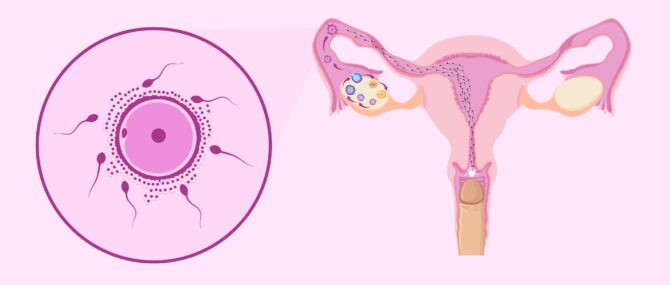 Obstacles of the female reproductive tract