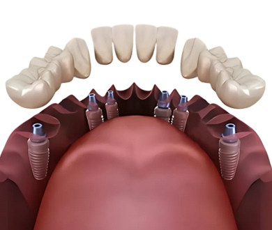 Dental Implant Prices in Costa Rica vs USA