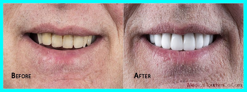 Dental Veneers Process Explained