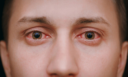 eye cold treatment